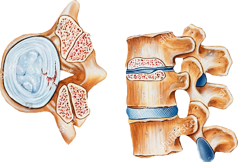 Spinal Stenosis