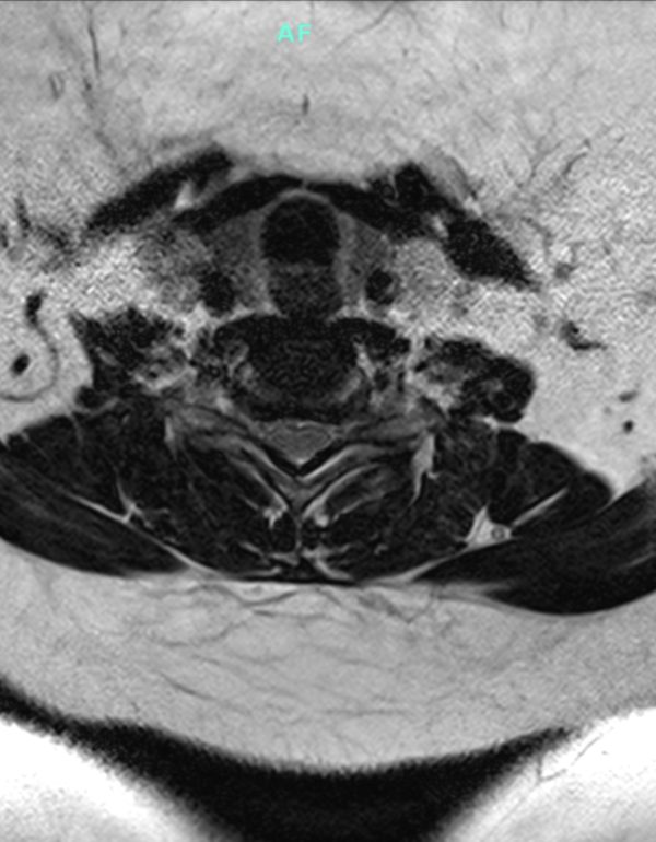Pre op bambou mri axial Pre op Bambou MRI Axial