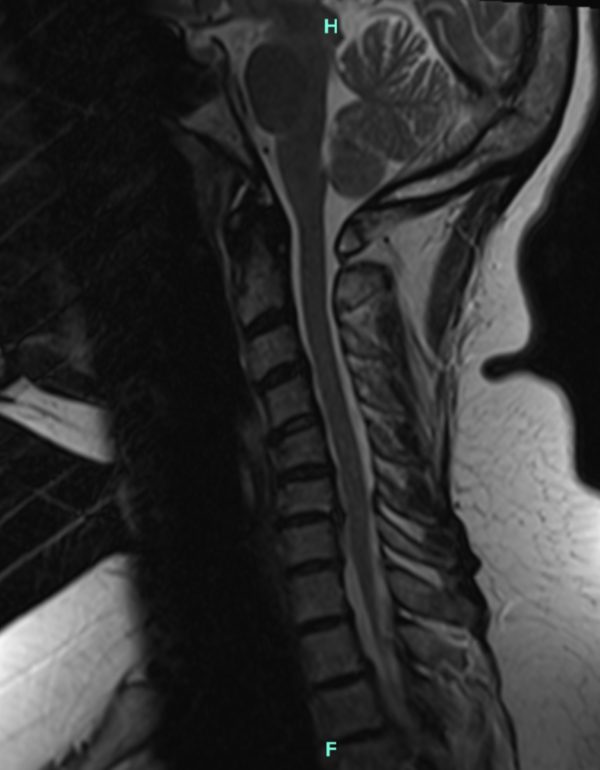 Pre op bambou mri sagital Pre op Bambou MRI sagital