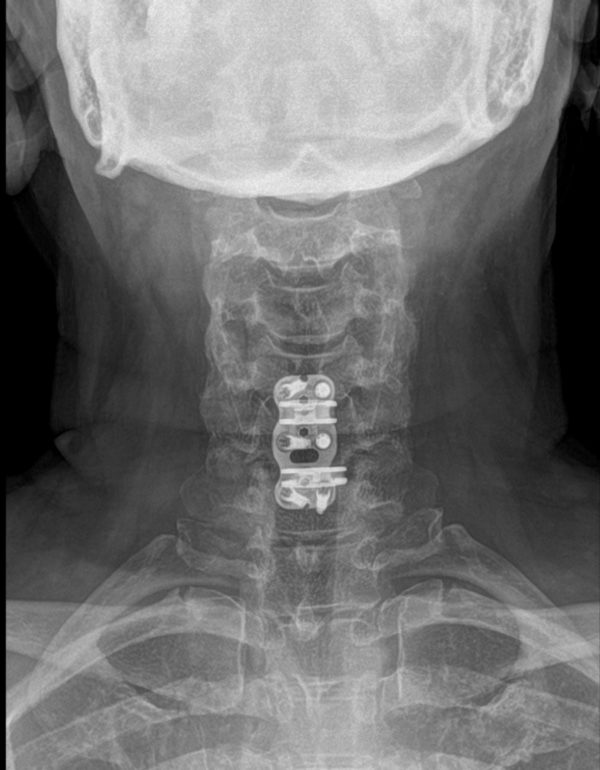 post op bambou ap x-ray post op Bambou ap x-ray