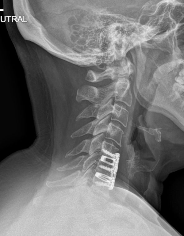 post op bambou lat x-ray pre op Bambou lat x-ray