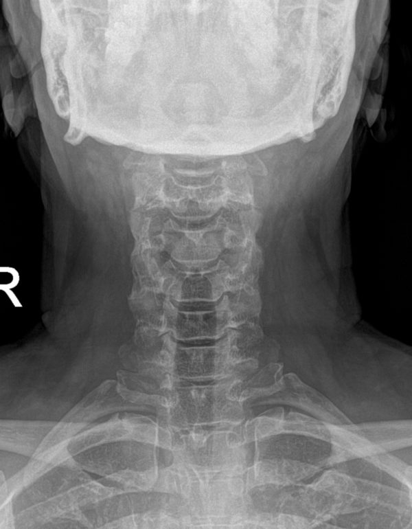 pre op bambou ap x-ray pre op Bambou ap x-ray