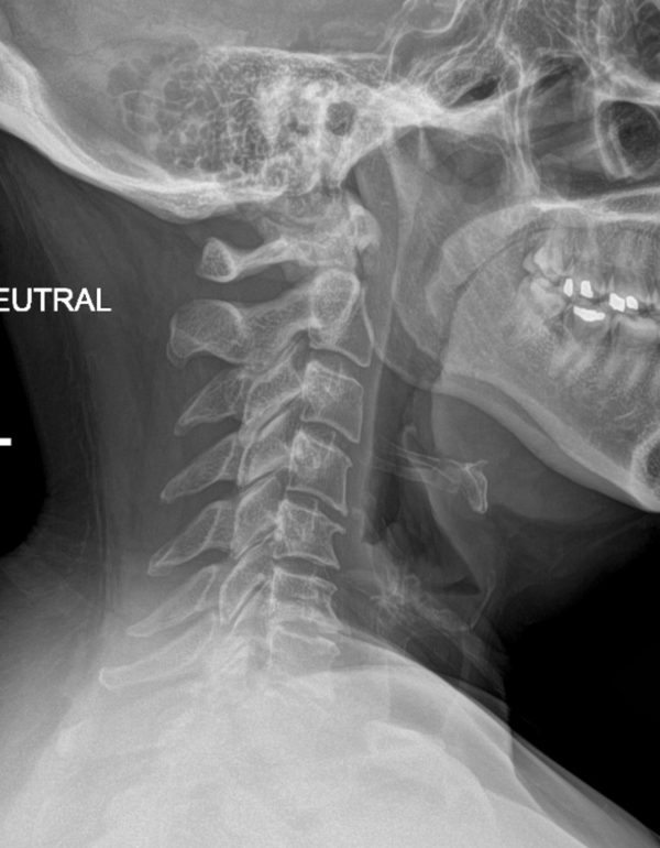 pre op bambou lat x-ray pre op Bambou lat x-ray