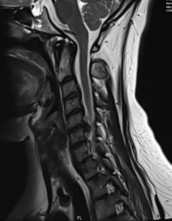 Waggoner Sagittal MRI Photo Wagonner Sagittal MRI