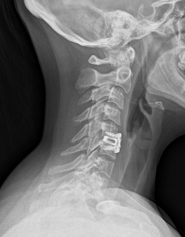 Wagonner Post Op Lateral Wagonner Post Op Lateral